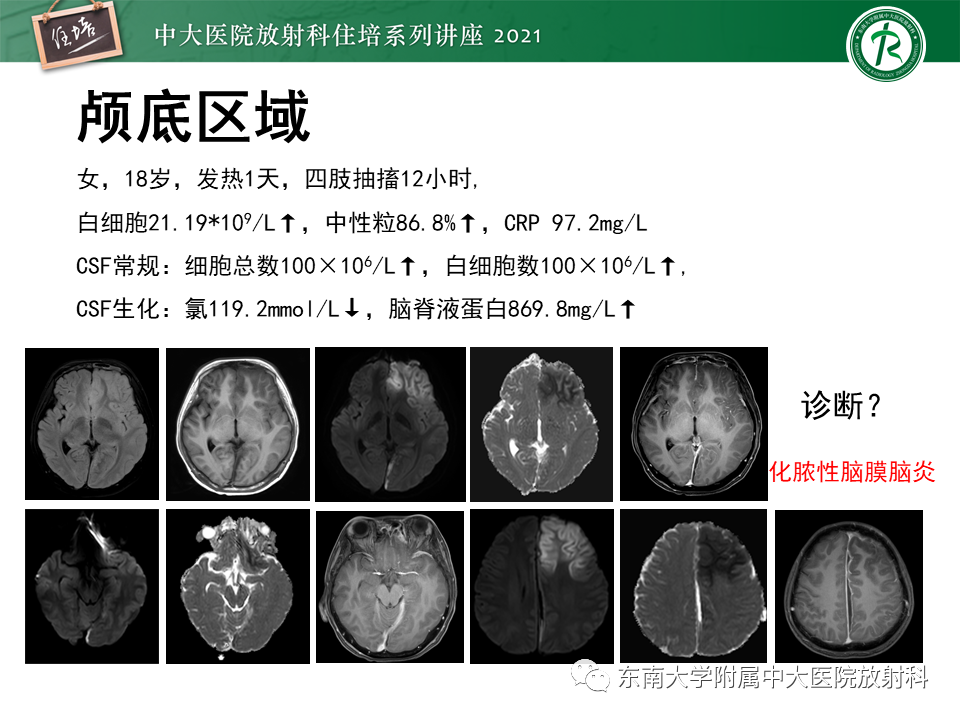 影像PPT - 【PPT】大脑皮层常见弥漫性病变的诊断思路-4