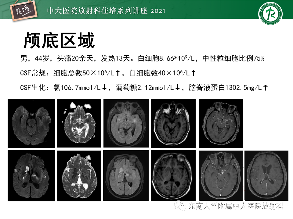 影像PPT - 【PPT】大脑皮层常见弥漫性病变的诊断思路-8