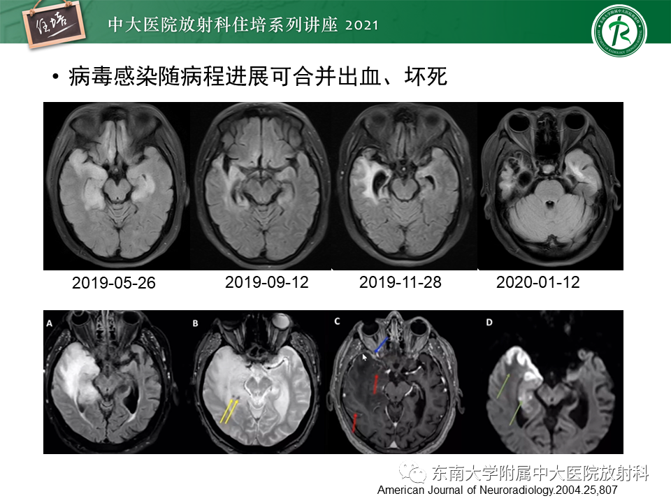 影像PPT - 【PPT】大脑皮层常见弥漫性病变的诊断思路-13