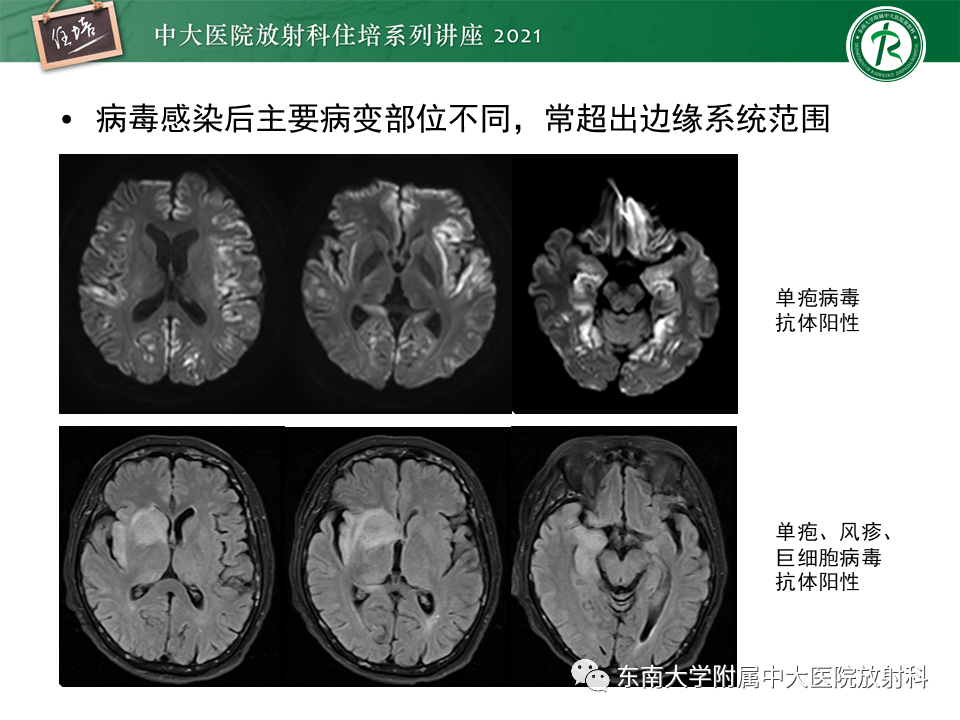影像PPT - 【PPT】大脑皮层常见弥漫性病变的诊断思路-14