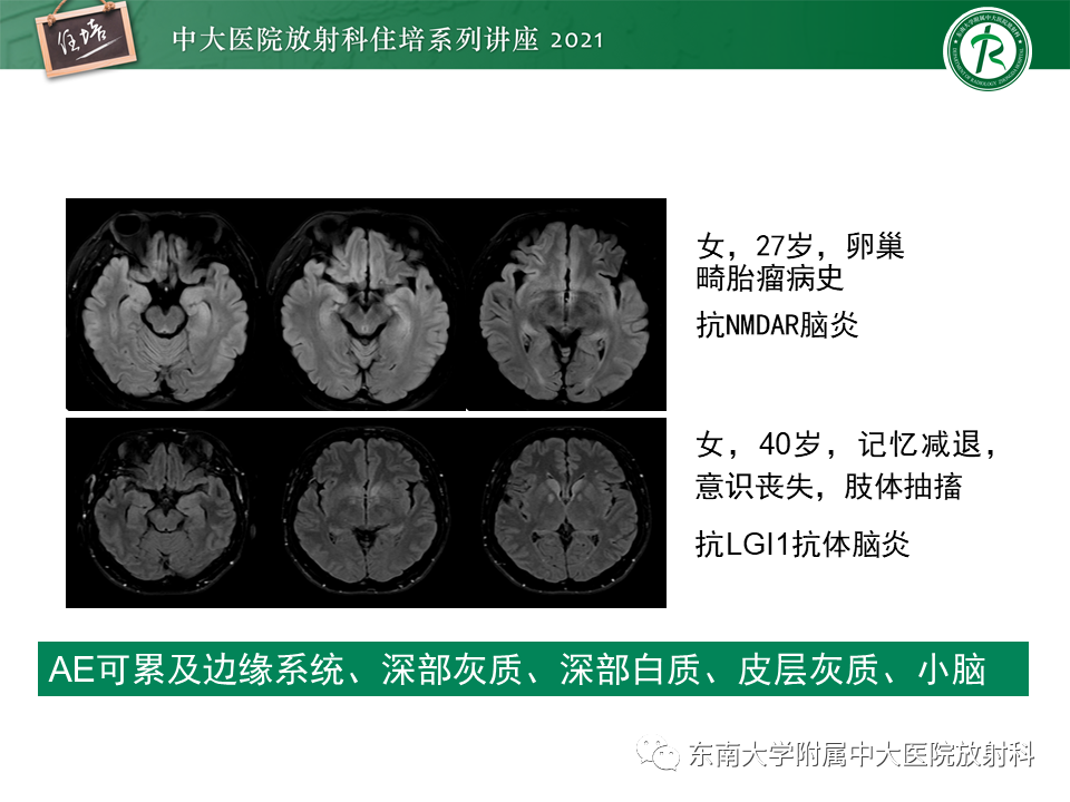 影像PPT - 【PPT】大脑皮层常见弥漫性病变的诊断思路-18
