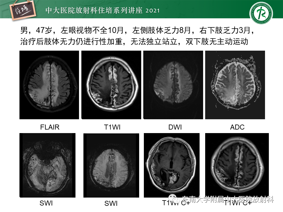 影像PPT - 【PPT】大脑皮层常见弥漫性病变的诊断思路-20