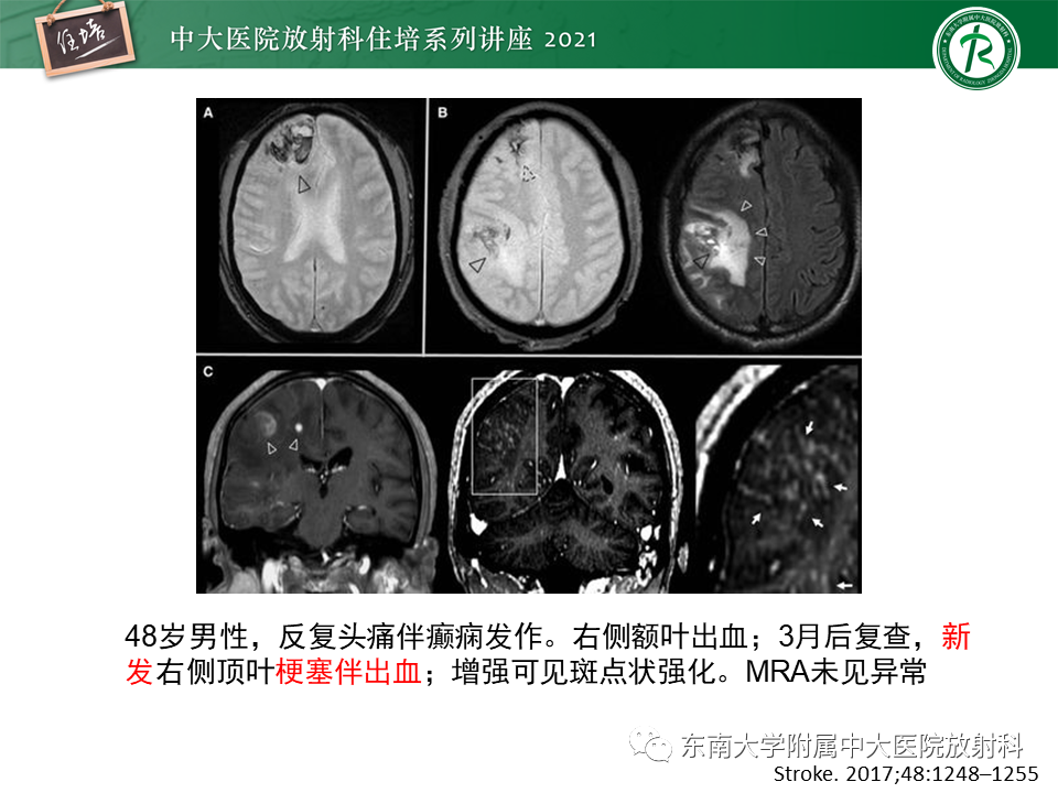 影像PPT - 【PPT】大脑皮层常见弥漫性病变的诊断思路-24