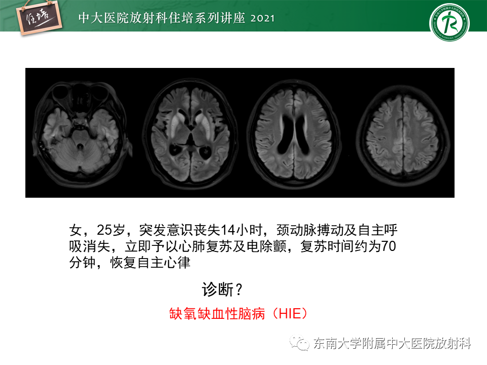 影像PPT - 【PPT】大脑皮层常见弥漫性病变的诊断思路-26