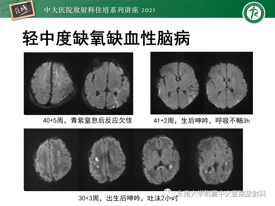 影像PPT - 【PPT】大脑皮层常见弥漫性病变的诊断思路-29