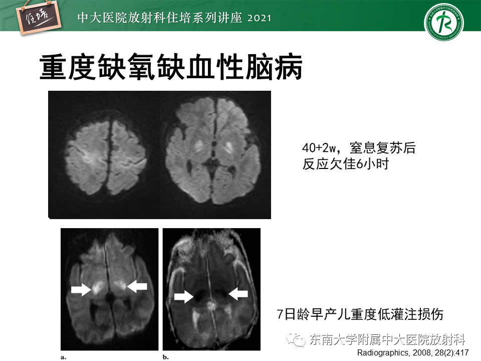 影像PPT - 【PPT】大脑皮层常见弥漫性病变的诊断思路-30