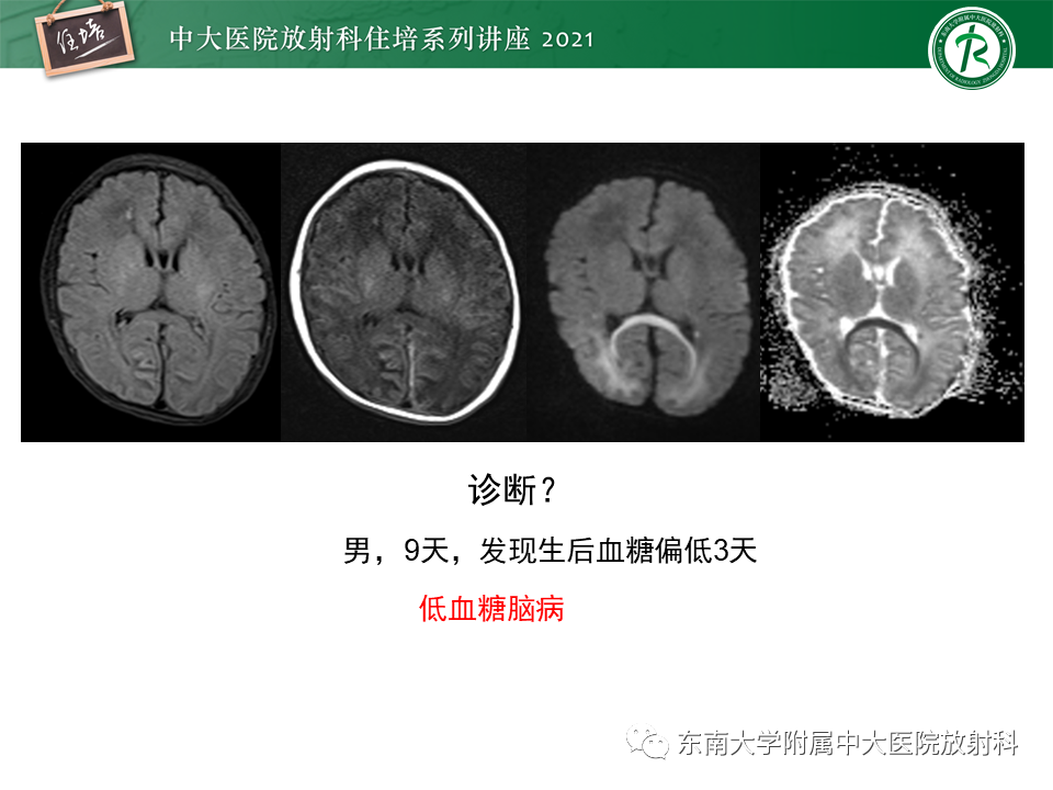 影像PPT - 【PPT】大脑皮层常见弥漫性病变的诊断思路-31