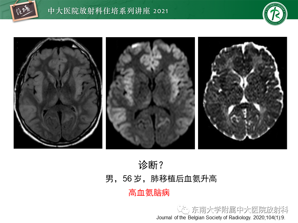 影像PPT - 【PPT】大脑皮层常见弥漫性病变的诊断思路-33