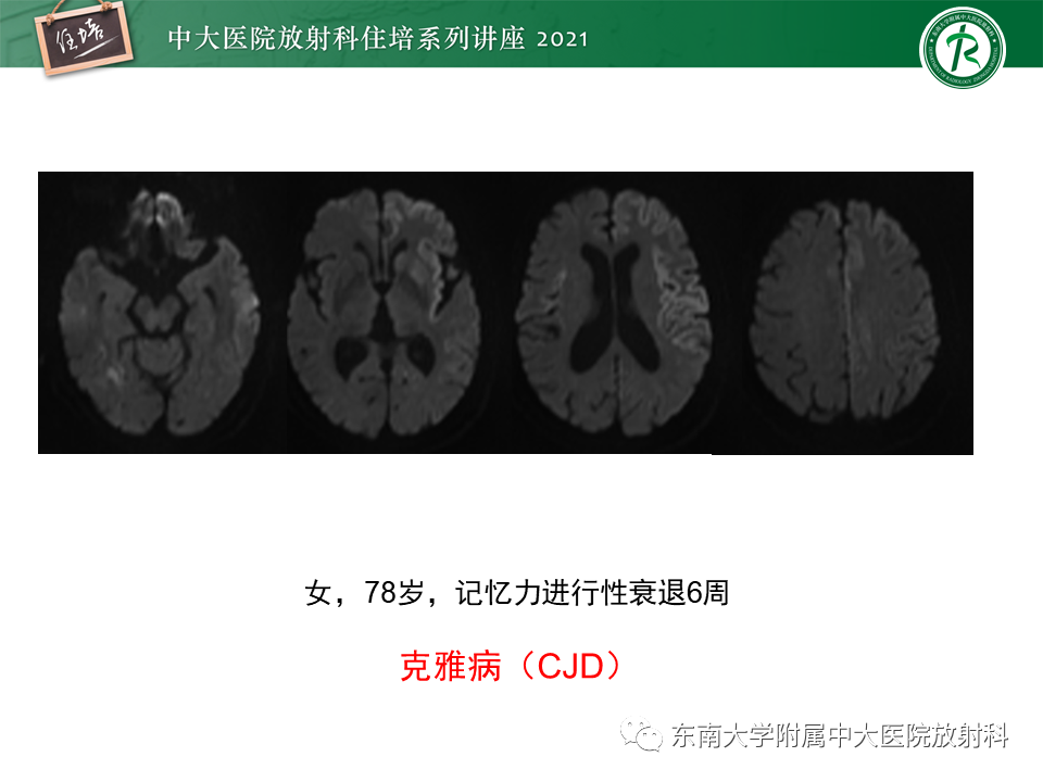 影像PPT - 【PPT】大脑皮层常见弥漫性病变的诊断思路-35