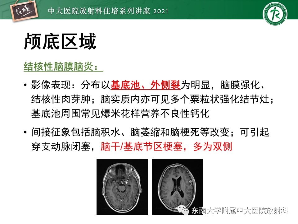 影像PPT - 【PPT】大脑皮层常见弥漫性病变的诊断思路-10