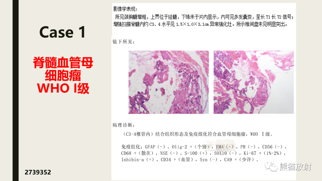 影像PPT - 【病例】脊髓血管母细胞瘤 VS 室管膜瘤-28