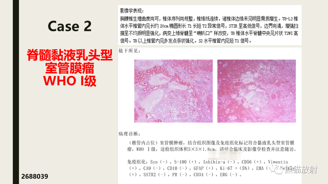 影像PPT - 【病例】脊髓血管母细胞瘤 VS 室管膜瘤-29
