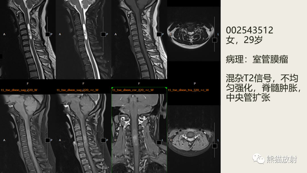 影像PPT - 【病例】脊髓血管母细胞瘤 VS 室管膜瘤-37