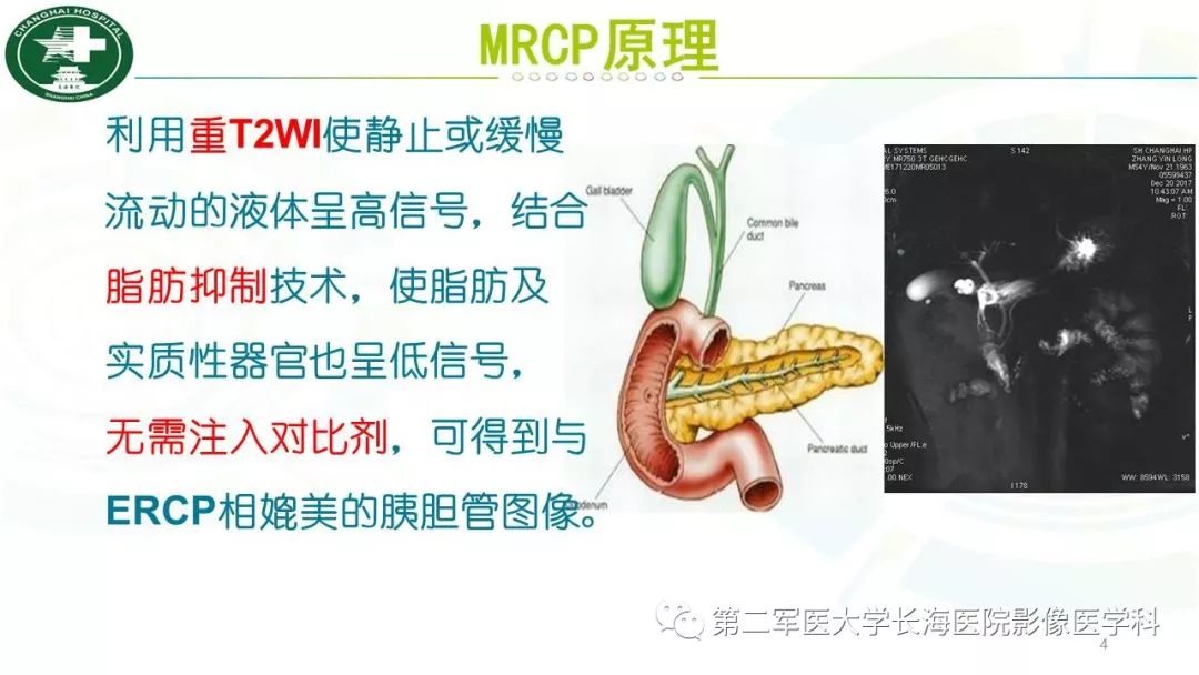 影像PPT - 【PPT】胰胆管水成像磁共振扫描规范-4