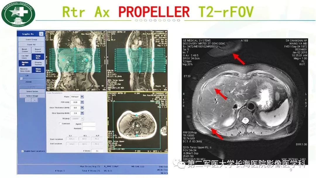 影像PPT - 【PPT】胰胆管水成像磁共振扫描规范-9