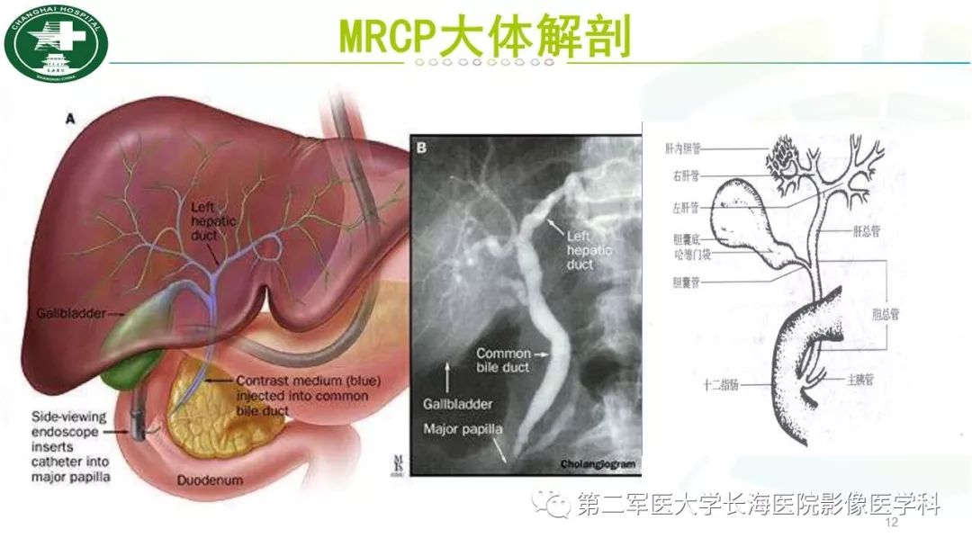 影像PPT - 【PPT】胰胆管水成像磁共振扫描规范-12
