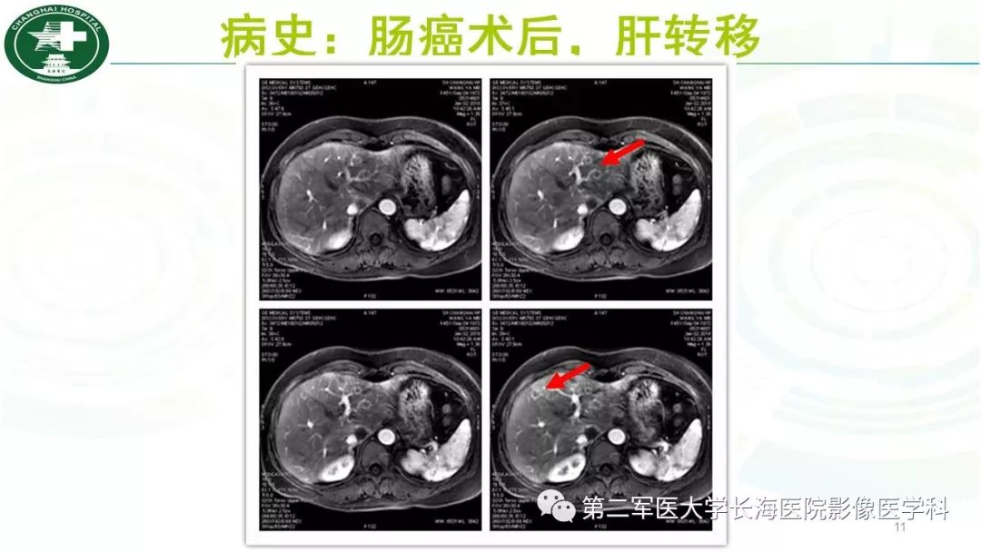 影像PPT - 【PPT】胰胆管水成像磁共振扫描规范-11