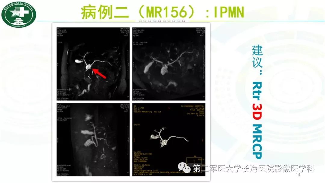 影像PPT - 【PPT】胰胆管水成像磁共振扫描规范-14