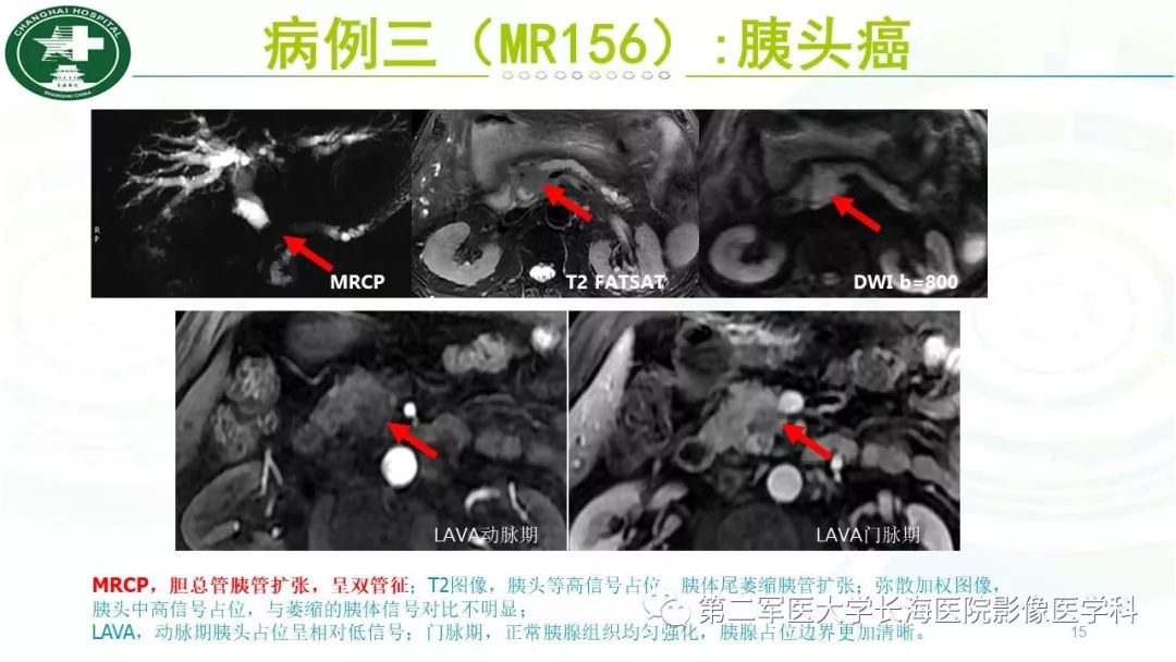 影像PPT - 【PPT】胰胆管水成像磁共振扫描规范-15