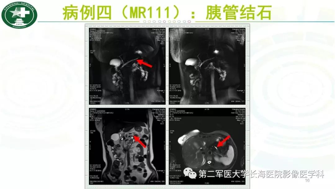 影像PPT - 【PPT】胰胆管水成像磁共振扫描规范-16