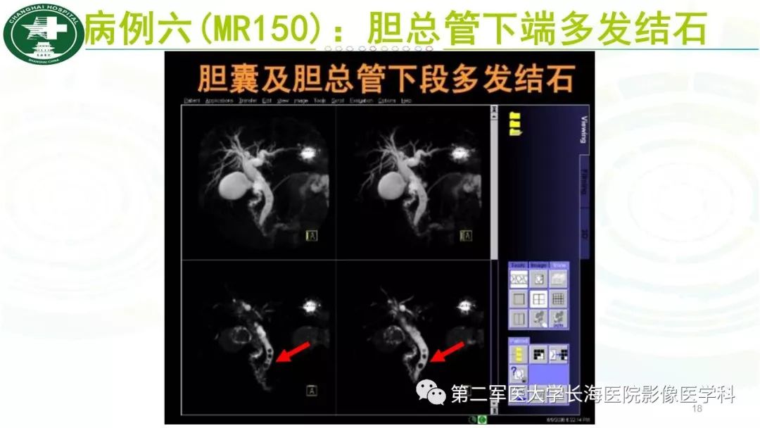 影像PPT - 【PPT】胰胆管水成像磁共振扫描规范-18
