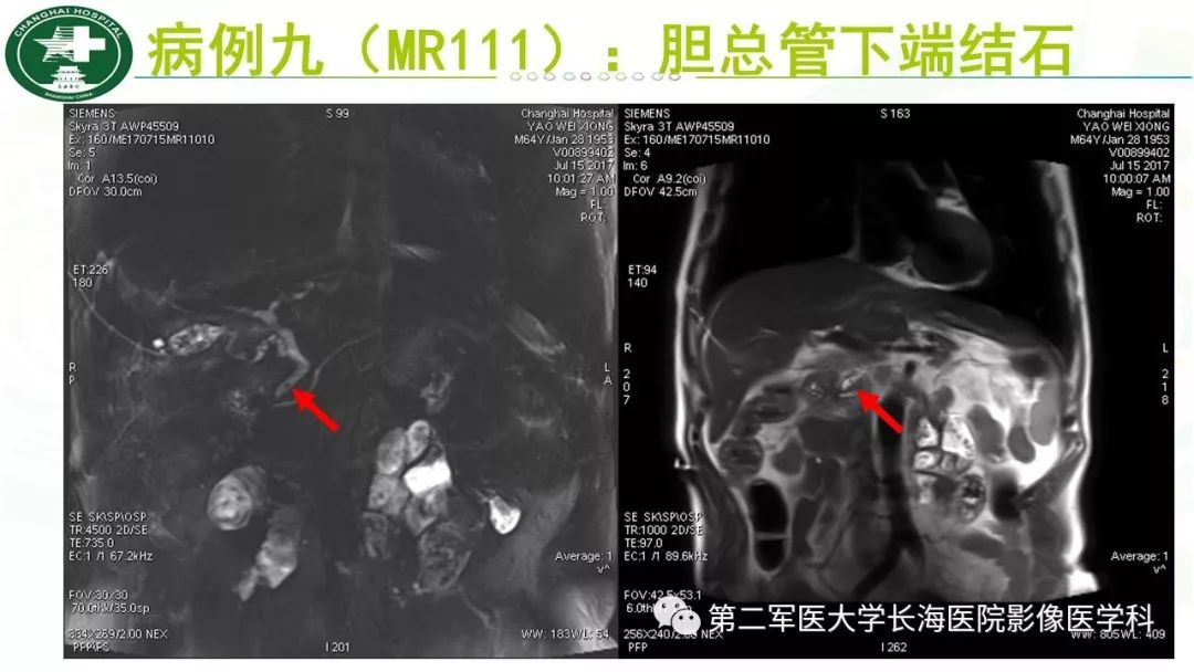 影像PPT - 【PPT】胰胆管水成像磁共振扫描规范-25