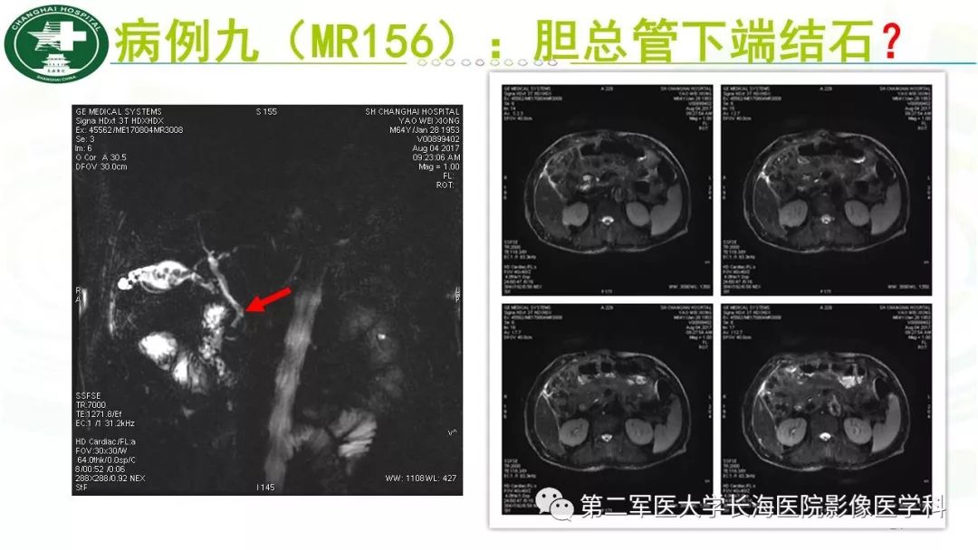 影像PPT - 【PPT】胰胆管水成像磁共振扫描规范-24