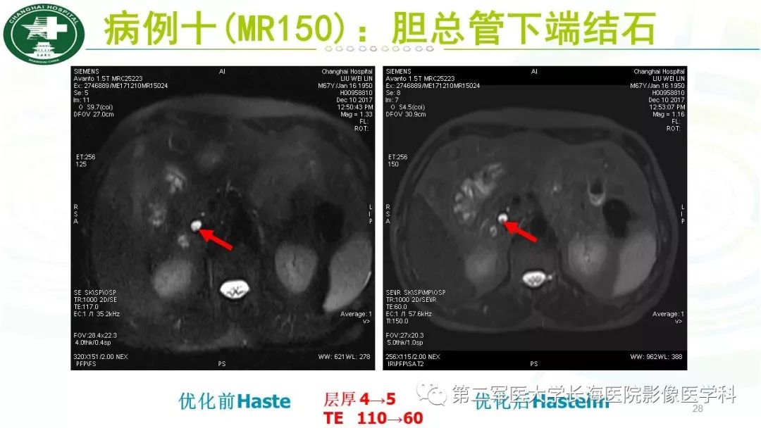 影像PPT - 【PPT】胰胆管水成像磁共振扫描规范-28