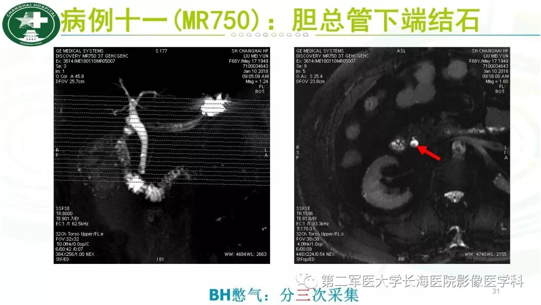 影像PPT - 【PPT】胰胆管水成像磁共振扫描规范-31
