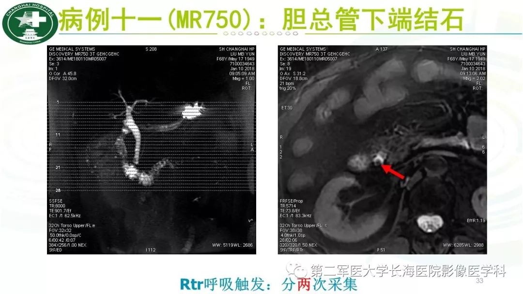 影像PPT - 【PPT】胰胆管水成像磁共振扫描规范-33