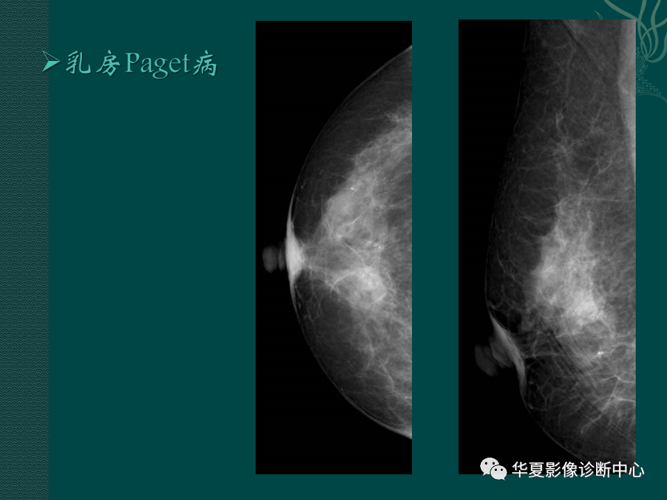 影像PPT - 【PPT】乳腺癌的特殊病理类型-14