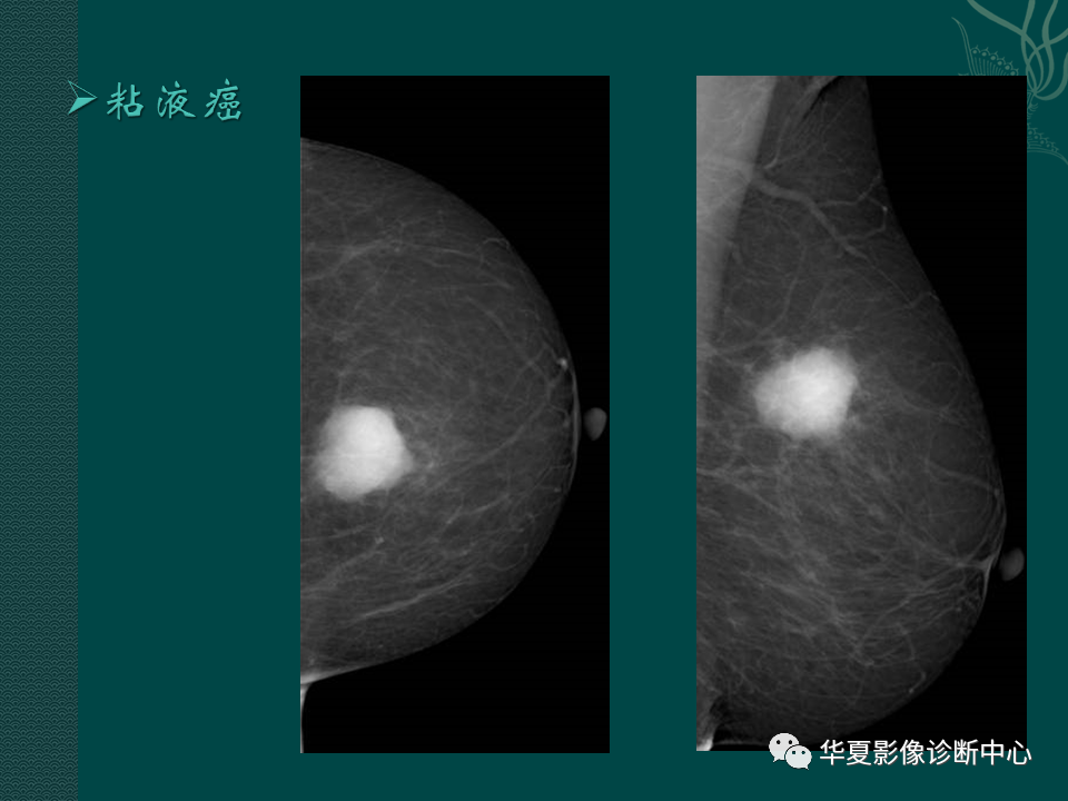 影像PPT - 【PPT】乳腺癌的特殊病理类型-33
