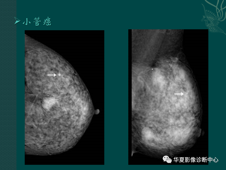影像PPT - 【PPT】乳腺癌的特殊病理类型-37