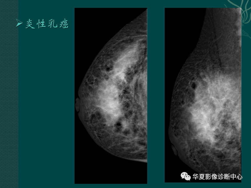 影像PPT - 【PPT】乳腺癌的特殊病理类型-41