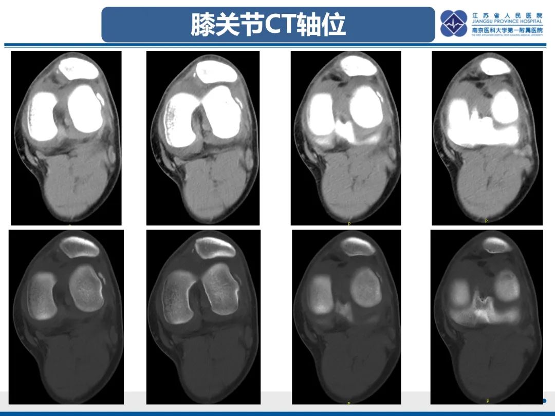 影像PPT - 【PPT】髌骨一过性外侧脱位-3