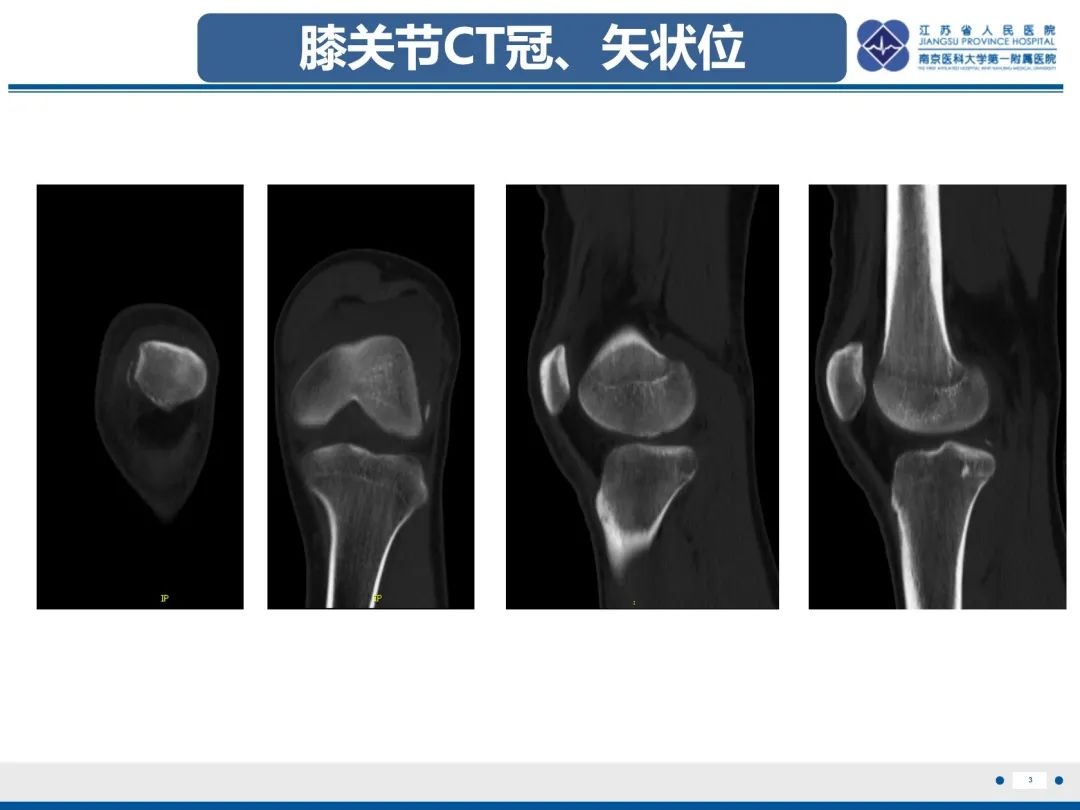 影像PPT - 【PPT】髌骨一过性外侧脱位-4