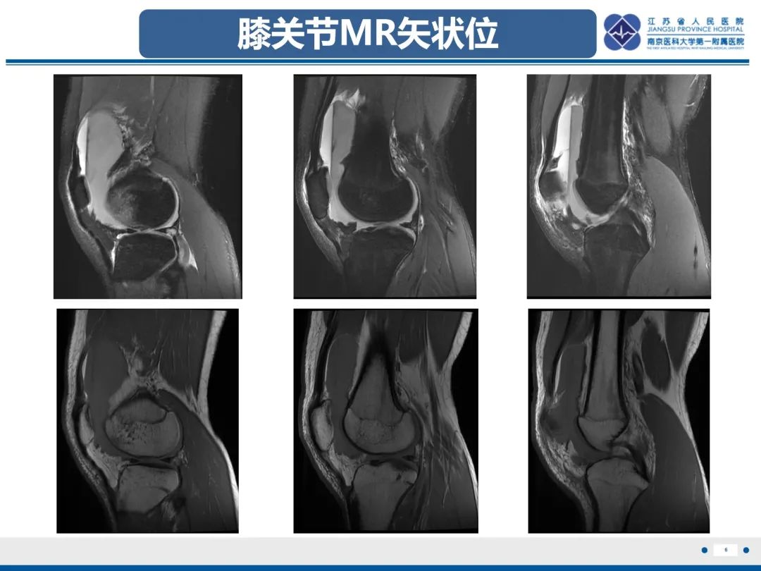 影像PPT - 【PPT】髌骨一过性外侧脱位-7