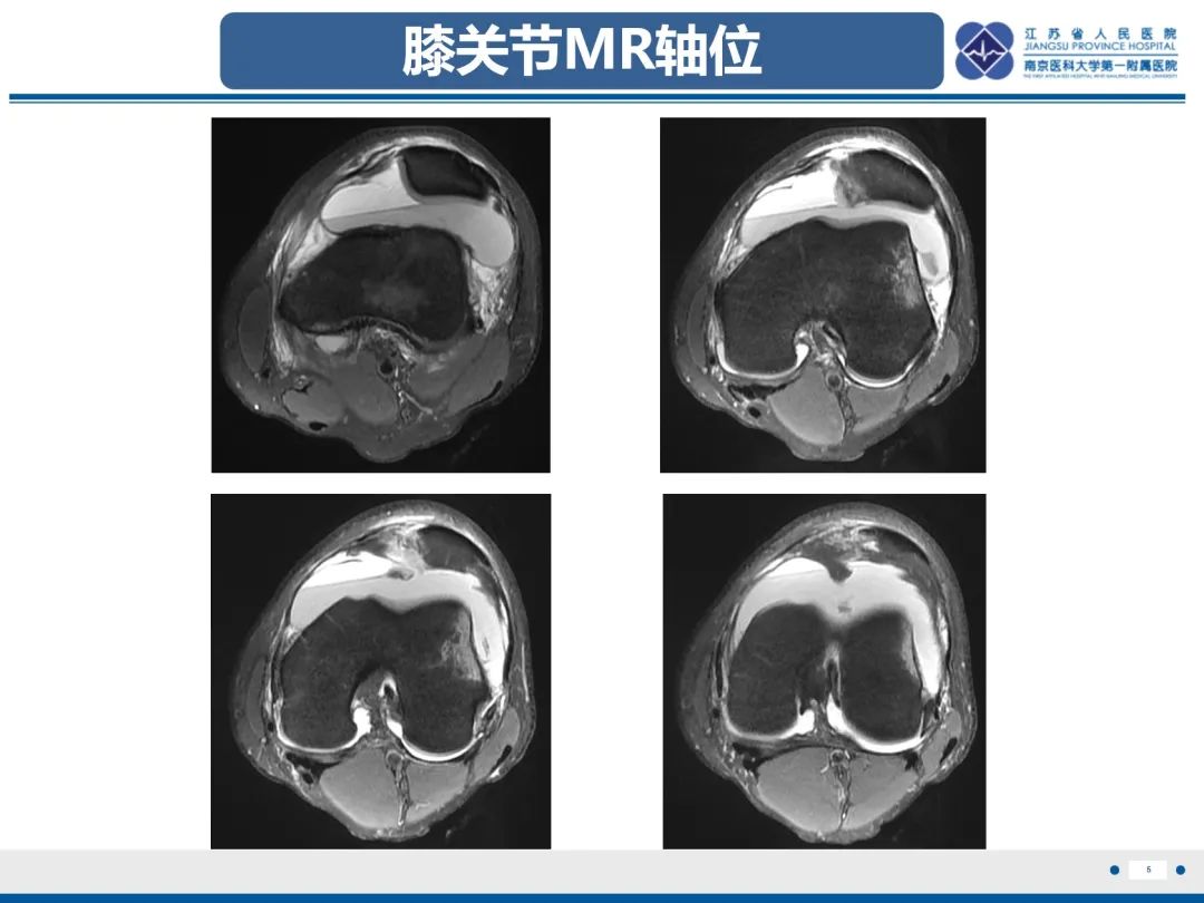 影像PPT - 【PPT】髌骨一过性外侧脱位-6
