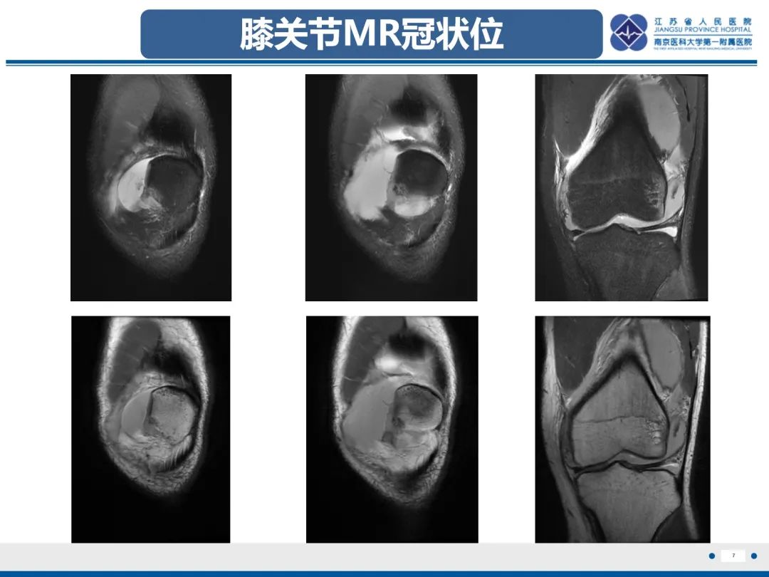 影像PPT - 【PPT】髌骨一过性外侧脱位-8