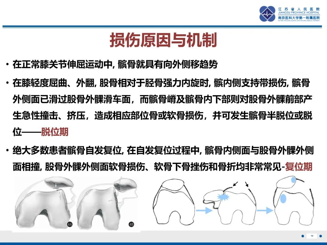 影像PPT - 【PPT】髌骨一过性外侧脱位-20