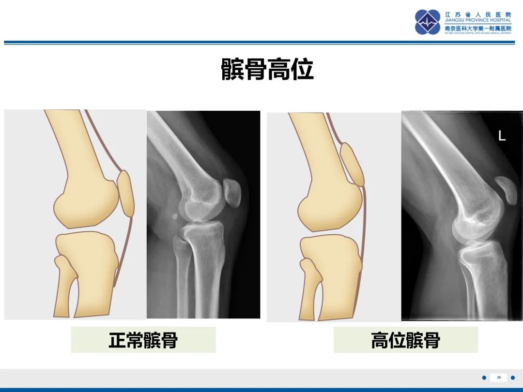 影像PPT - 【PPT】髌骨一过性外侧脱位-27