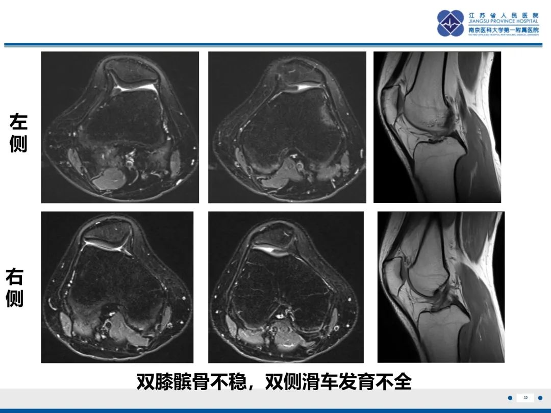 影像PPT - 【PPT】髌骨一过性外侧脱位-33