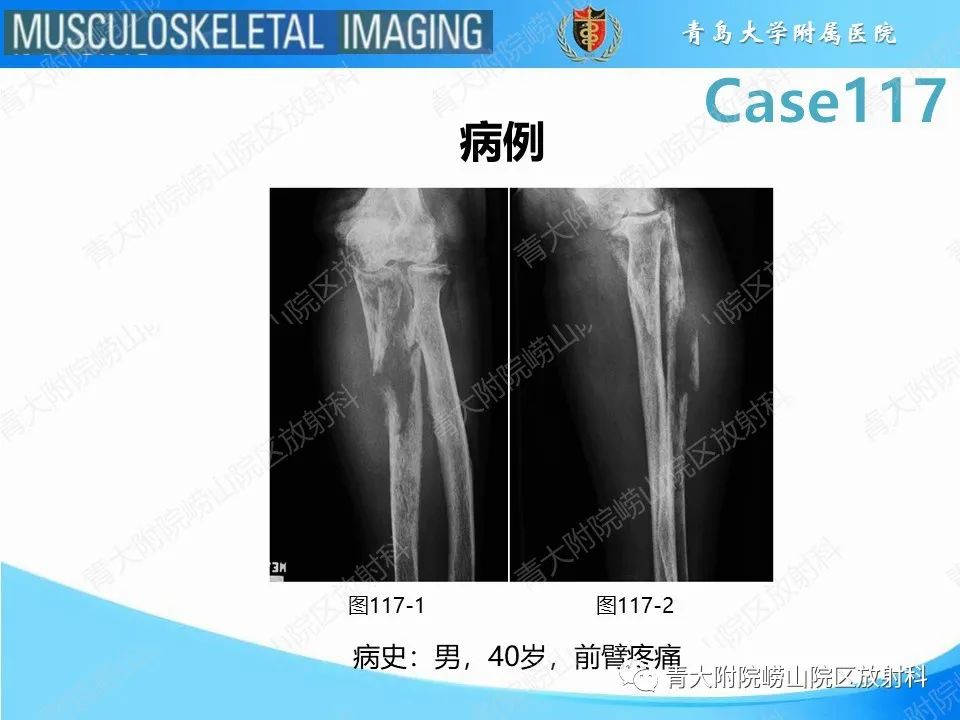 影像PPT - 【PPT】原发性骨淋巴瘤-2