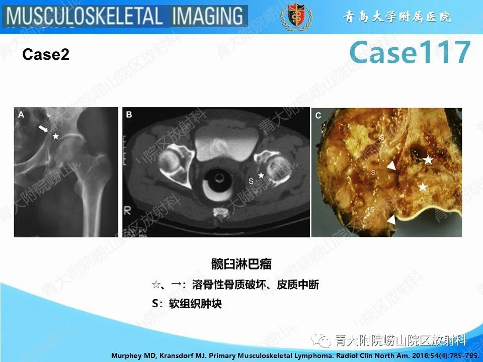 影像PPT - 【PPT】原发性骨淋巴瘤-9