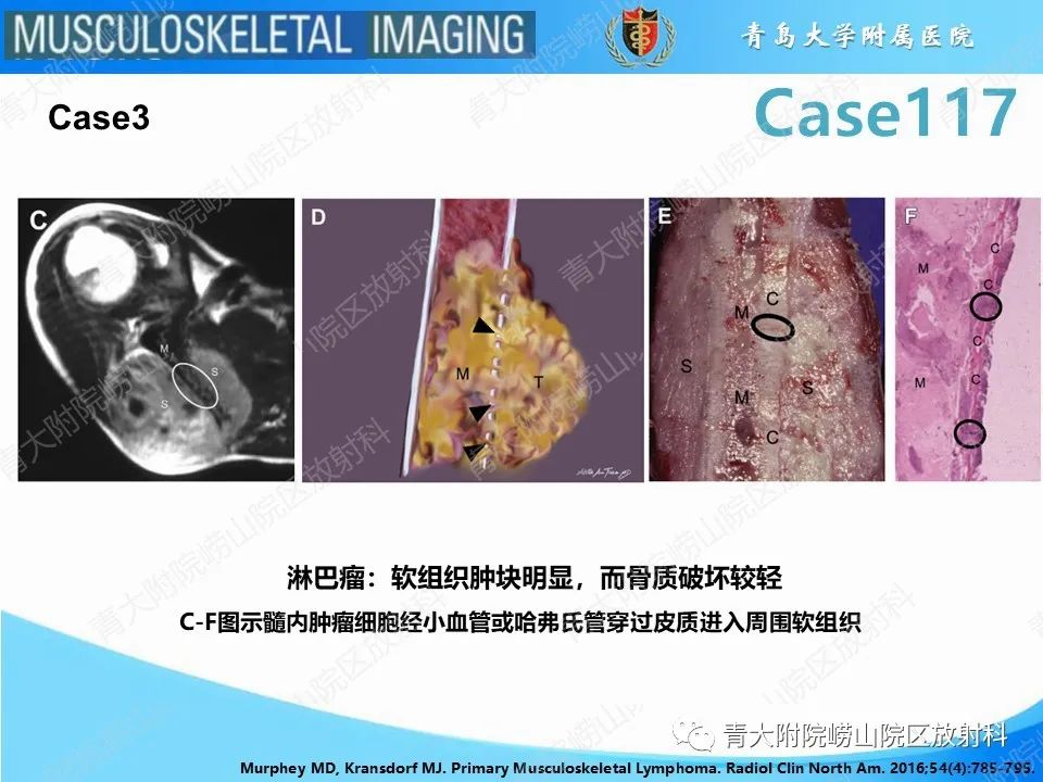 影像PPT - 【PPT】原发性骨淋巴瘤-10