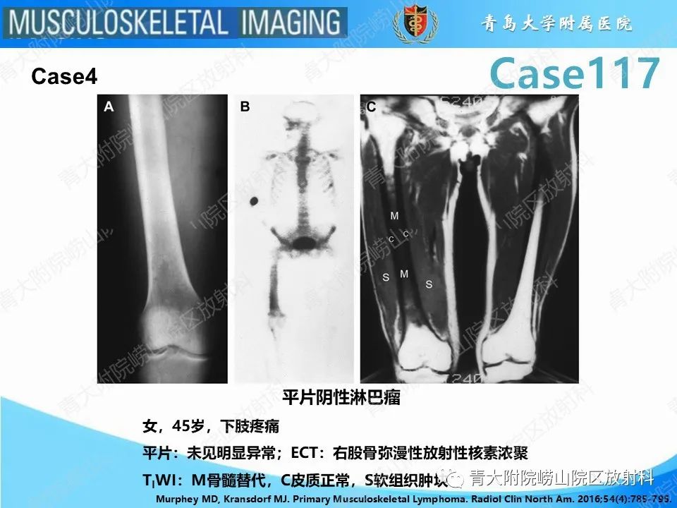 影像PPT - 【PPT】原发性骨淋巴瘤-11
