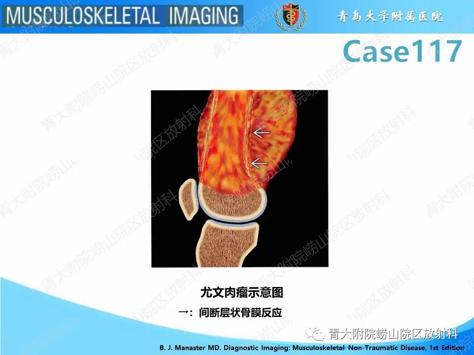影像PPT - 【PPT】原发性骨淋巴瘤-14
