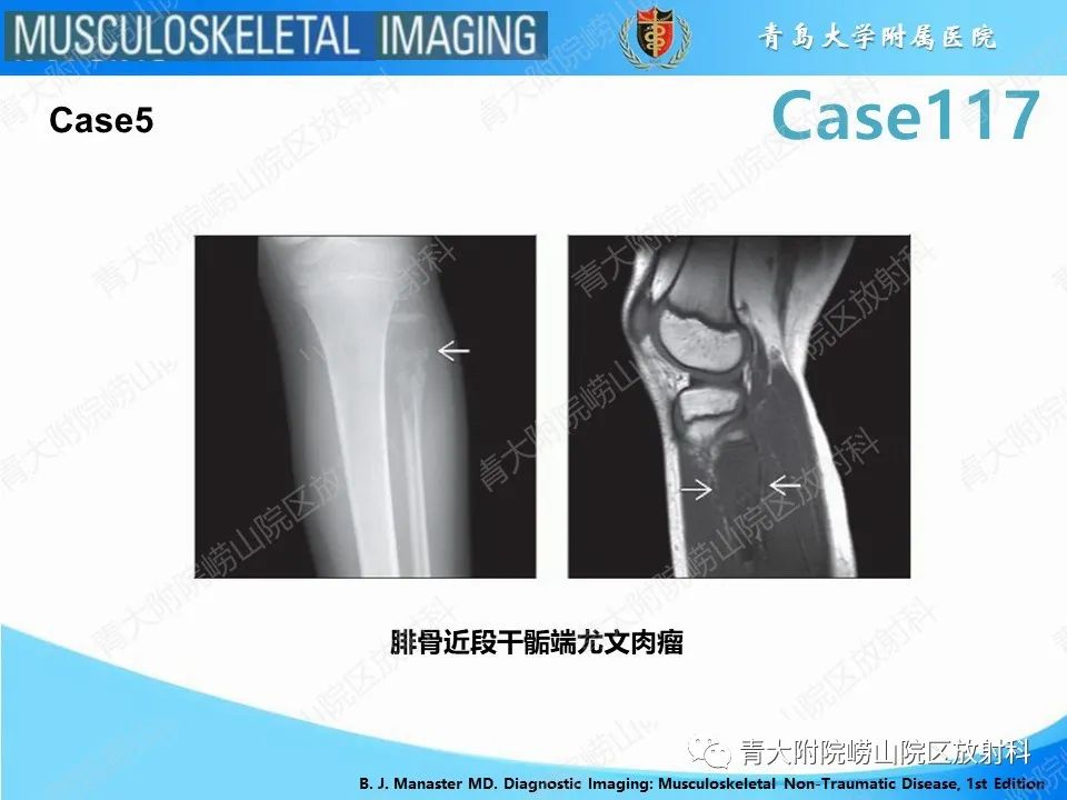 影像PPT - 【PPT】原发性骨淋巴瘤-15