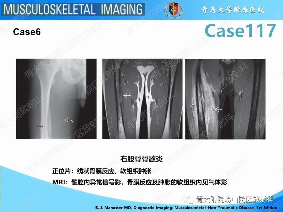 影像PPT - 【PPT】原发性骨淋巴瘤-18
