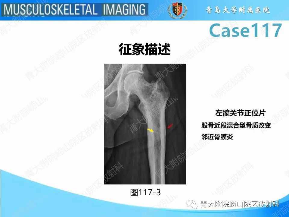 影像PPT - 【PPT】原发性骨淋巴瘤-26